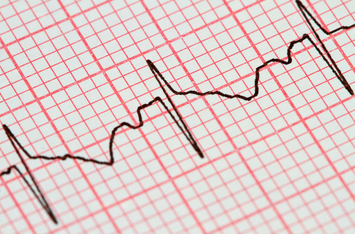 electrocardiogram